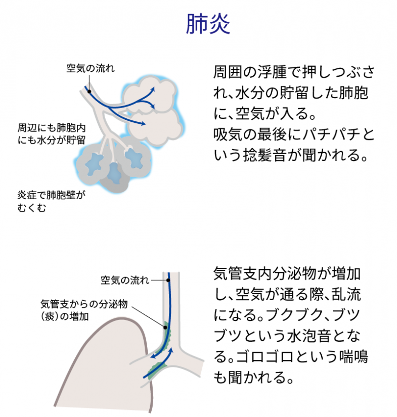 2 嘔吐した後 呼吸時にゼロゼロと音がする Nspace ナースペース 家で 看る あなたを支える