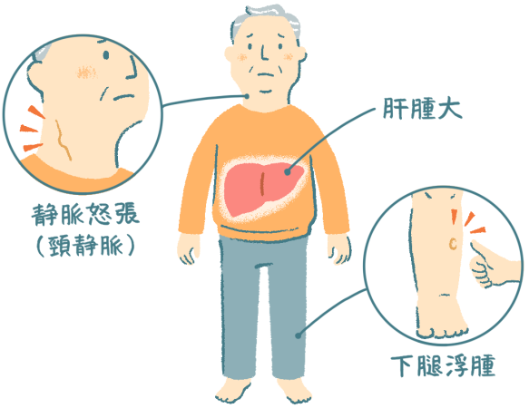 右心不全の所見