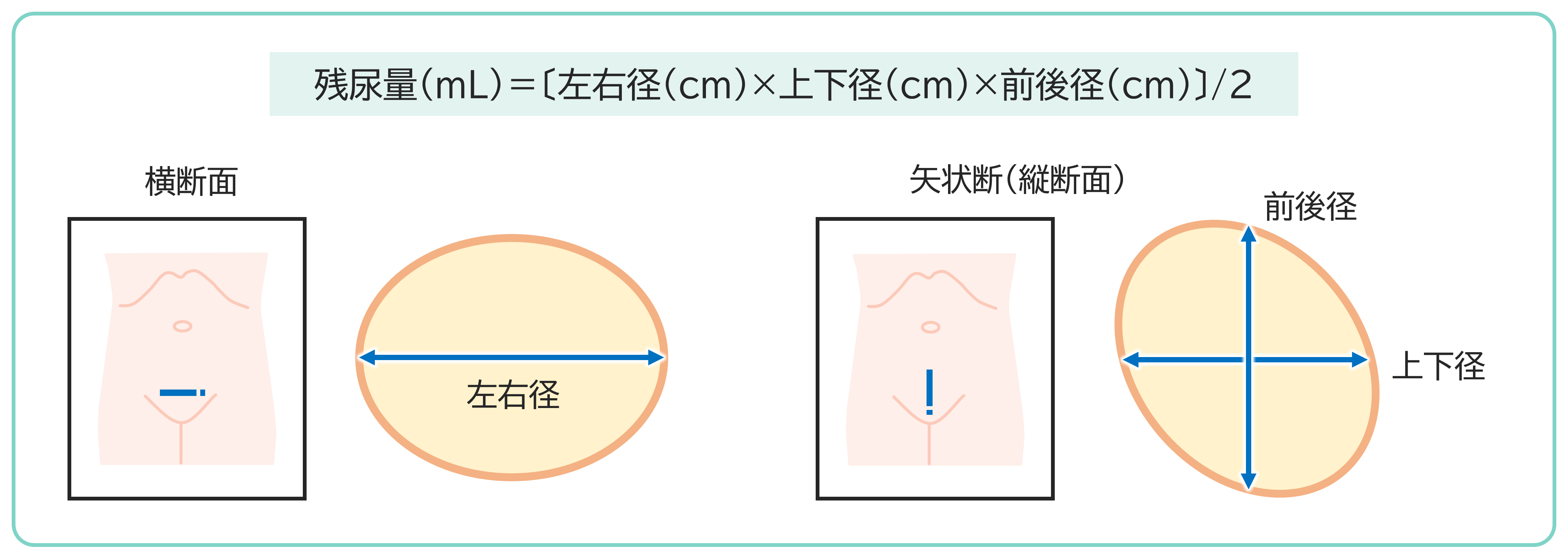 超音波検査による残尿量の測定方法