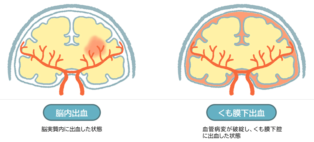 脳内出血とくも膜下出血