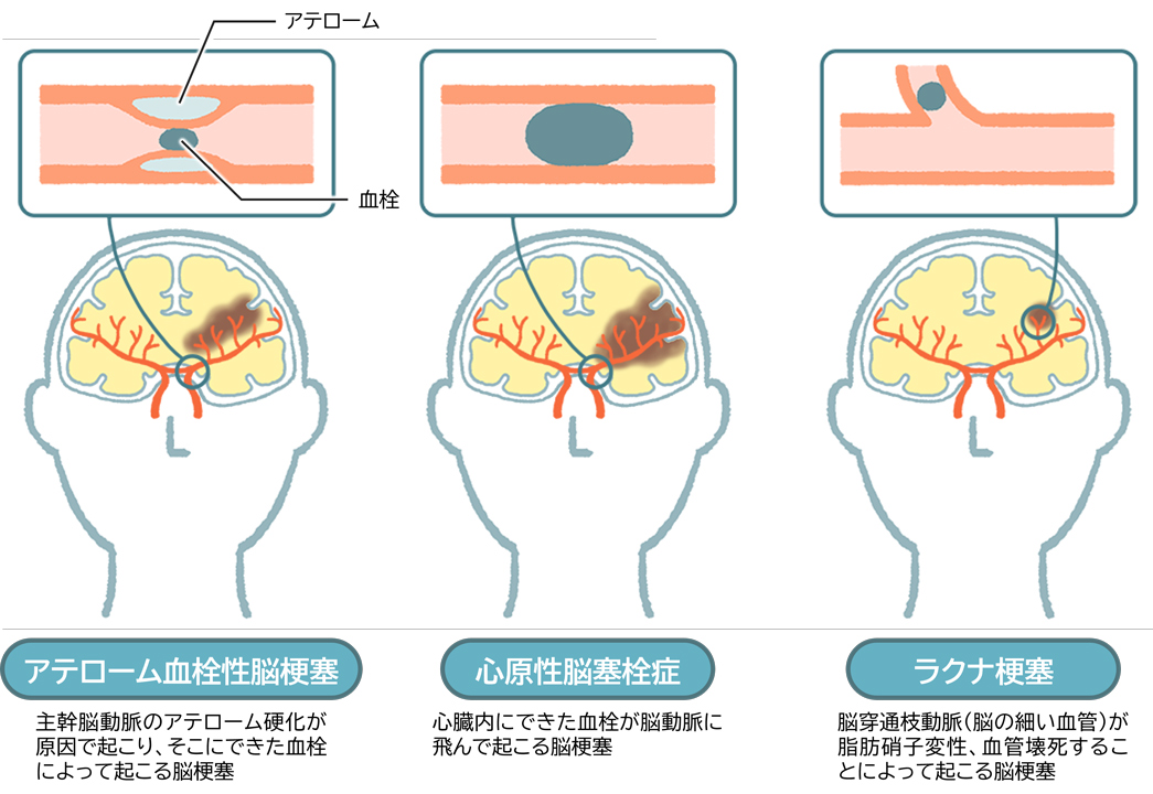 脳梗塞の種類