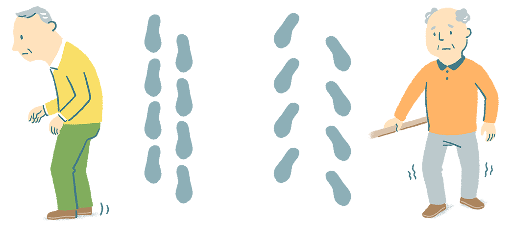 パーキンソン病と脳⾎管障害性パーキンソニズムおよび正常圧⽔頭症の歩⾏の違い